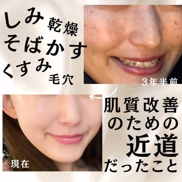 肌質改善のための近道だったこと🏃🏃‍♀️
.
こんにちは、マイキです😌🫱
さてさて今日は
恒例のスキベぶち上げ大会に加えて、美容医療とホームケアの両立について
つらつらと語らせていただきました🧎‍♀️🧎‍♀️
.
やっぱりどうしてもシミやら毛穴やらシワやらくすみやら、無限に出てくる肌悩みを一発で解決してやろうやないの！いざ美容クリニック！鼻息！！みたいなかんじで施術してみるのものの思ったような効果が得られなくて
高かったのにいぃい！私の肌は諦めるしかないんやろうか、と絶望した経験をお持ちの方多いのではないでしょうか🧎‍♀️
何を隠そう私もその1人でして
わけもわからずとりあえずクリニックへ行ってみては効果が得られず、ちゃぶ台ひっくり返した日もありました(私の家にちゃぶ台はありません)
.
でもやっぱりいろいろと勉強していくうちに
クリニックの施術だけでは効果を得づらいこと、ホームケアと両立すれば最短距離で肌悩み解決に近づけることに気がつきました🤲✨
.
そしてそこからスキンケアって3150！すごい！テバ！！！となりまして沼にハマっていったわけでございます
.
そして妊娠中はもちろん産後もバタバタでなかなか時間を使って作れず、しばらく美容医療から離れた生活を送っていたわけですが、妊娠・産後に起こりやすいシミの出現も無事0に抑えこむことができまして
超シミ体質の私としてはやっぱりスキンケアって裏切らんなぁ(すべらんなぁ風)となりました
.
極端にスキンケアだけ！美容医療しか勝たん！ではなく
それぞれのいいところをうまく使ってケアしていけると
理想のお肌まで最短距離で駆け抜けていねるのではないかしらとそんなふうに思いました🤲🤲
.
.
.

#シミケア #そばかす #そばかす治療 #シミ取り #シミ対策 #シミレーザー #スキンケア #スキンケアマニア #スキンケア好きさんと繋がりたい #フォトフェイシャル #シミ改善 #スキンケア用品 #美容皮膚科 #ツヤ肌 #すっぴん #スキンケア大好き #スキンケアレポ #シミ #そばかす #アンチエイジング #夜スキンケア　#韓国コスメ #韓国コスメレビュー #韓国コスメ購入品